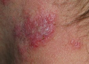 Die helle Vorwölbung und Rötung sprechen für eine ausgeprägte Entzündung in der oberen Dermis mit ektatischen Gefäßen